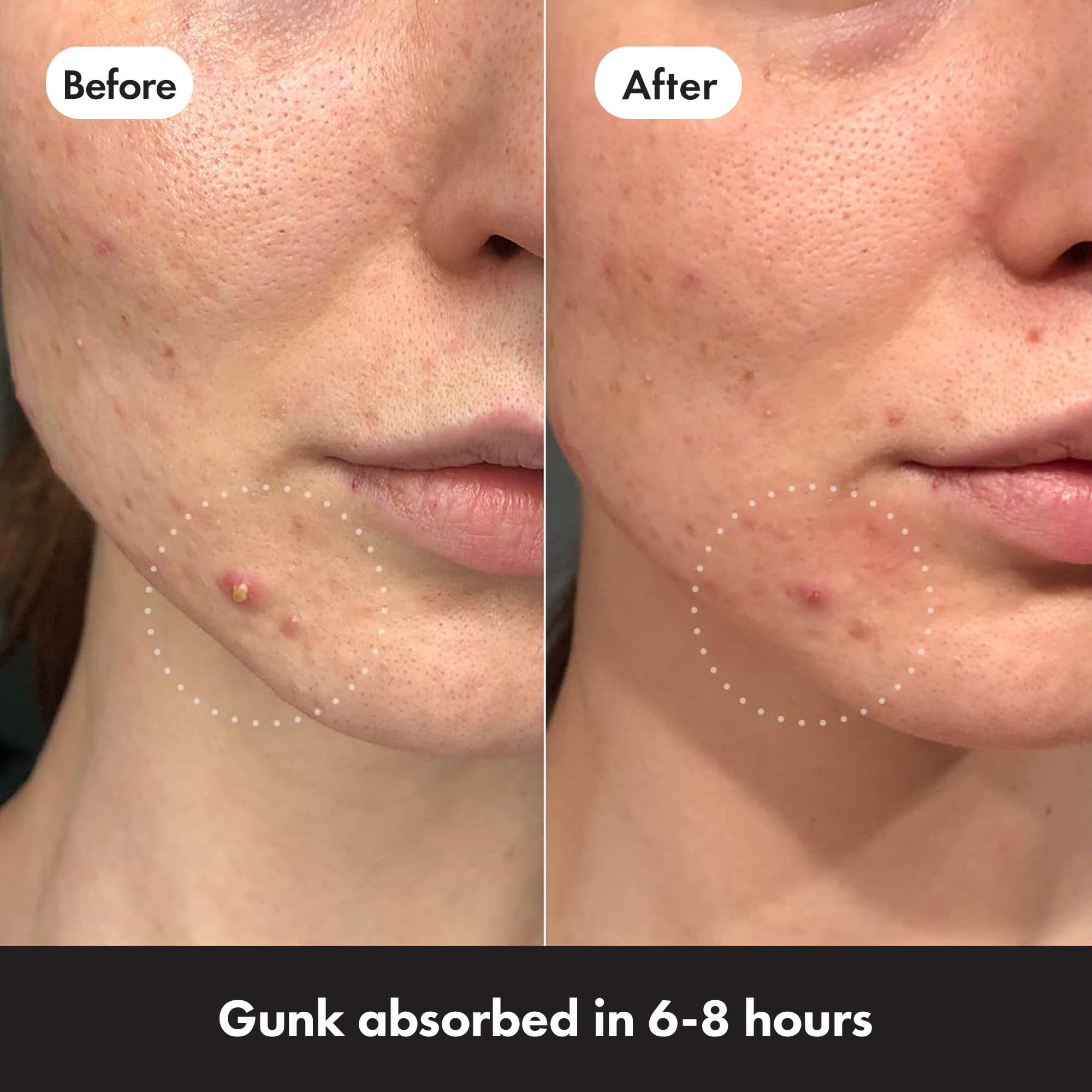 Hero Cosmetics - Mighty Patch Original Spot Patches (72 Count) 6